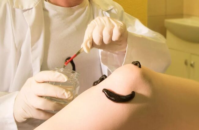 Hirudotherapie bei Krampfadern