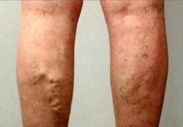 Thromboembolismus