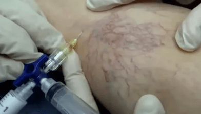 Sklerotherapie bei Krampfadern