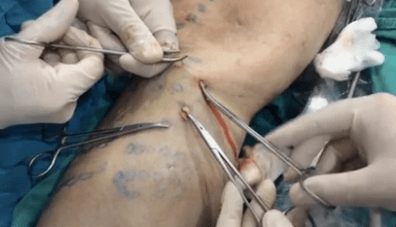 Wie wird eine Venenentfernung zur Entfernung von Krampfadern durchgeführt